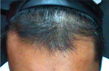 Keralase Hair Restoration Before and After Results