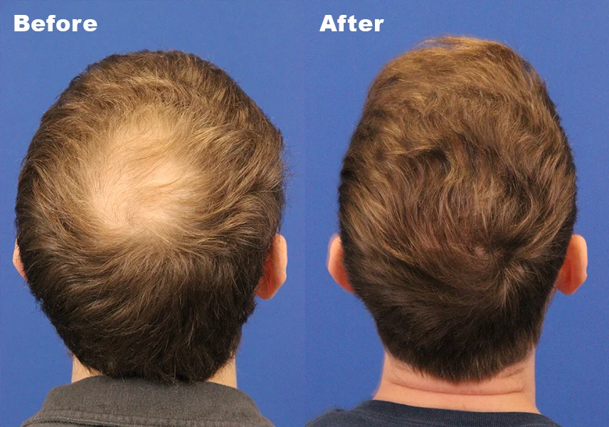 FUE hair transplant Patient 2 before and after photos highlighting restored hair growth