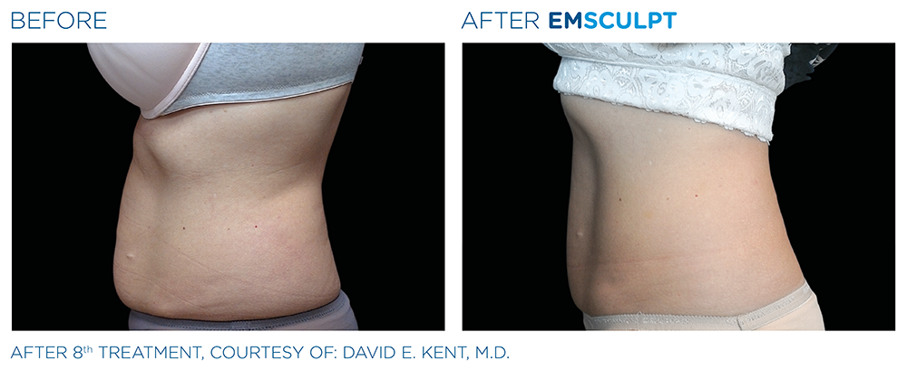 EMSCULPT NEO treatment