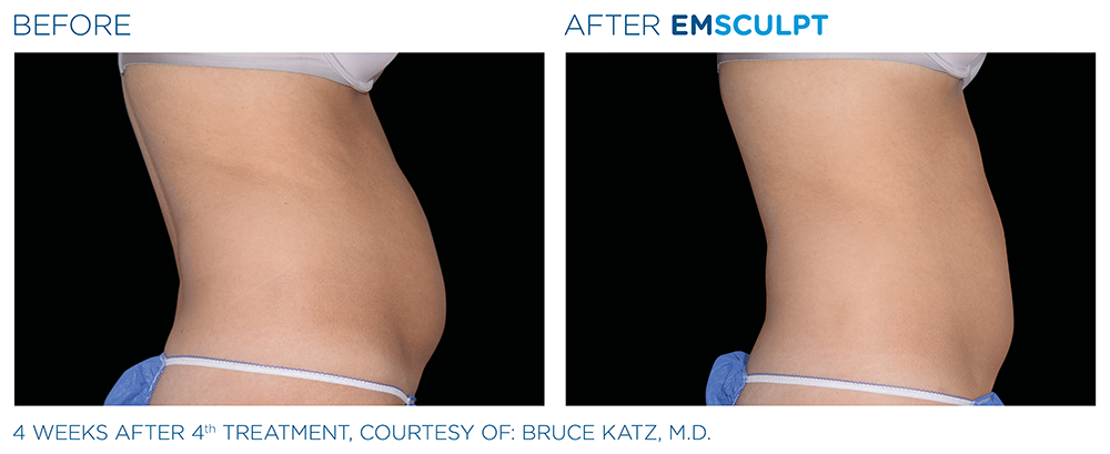 EMSCULPT NEO treatment