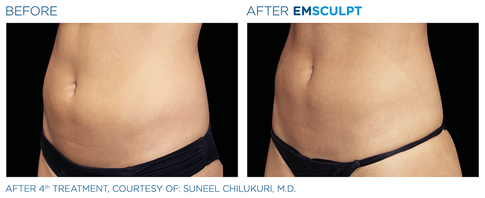 EMSCULPT NEO treatment