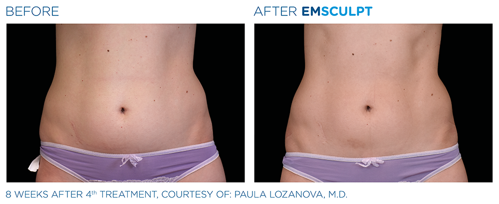 EMSCULPT NEO treatment