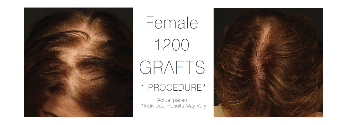 FUE Hair Transplant Female - before and after