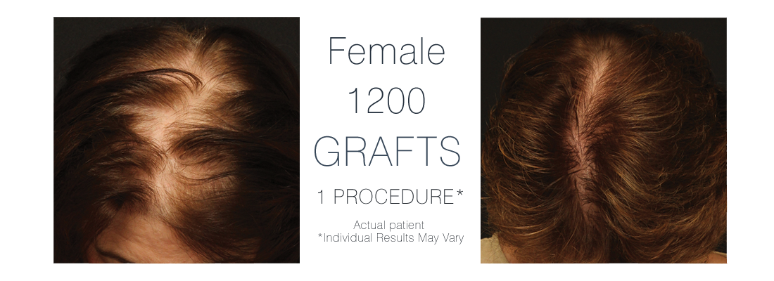 FUE Hair Transplant Female - before and after