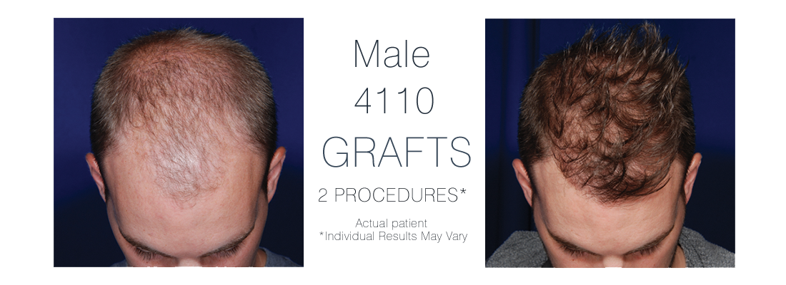 FUE Hair Transplant Male - before and after