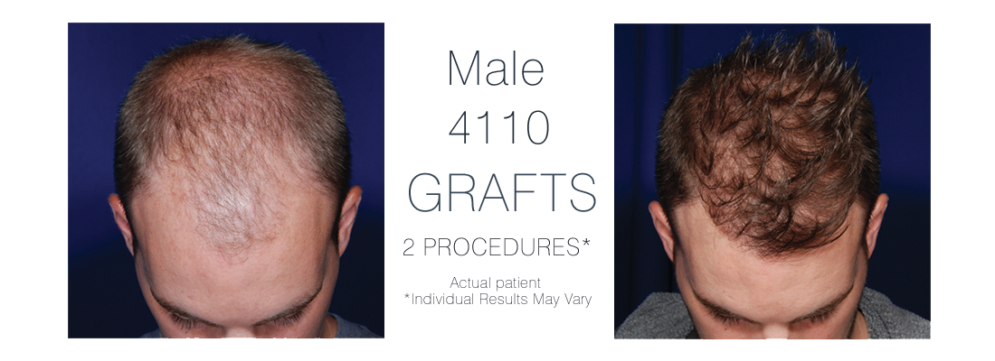 FUE Hair Transplant Male - before and after