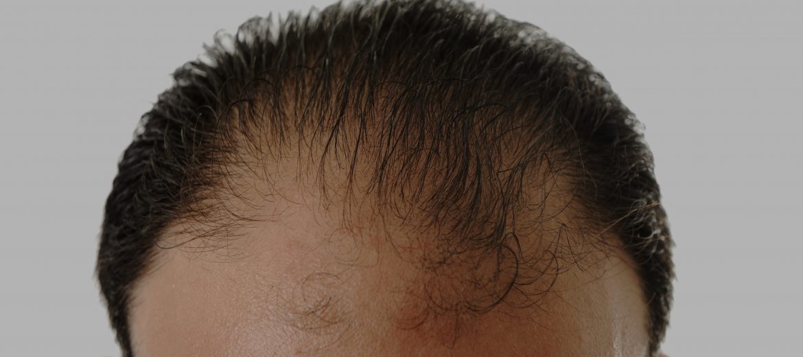 Hair Transplant For Women