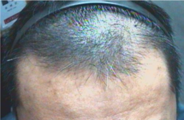 Keralase Hair Restoration Before and After Results