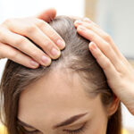 Understanding Hair Loss in Women