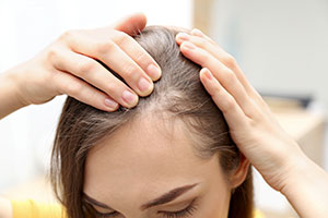 Young woman with hair loss problem