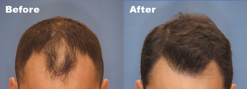 Photo of the patient’s Before & After the . Follicular Unit Excision – Patient 1 - Set 1