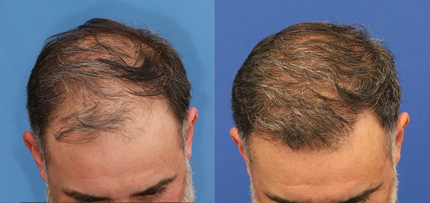 Follicular Unit Excision – Patient 3 – Before & After