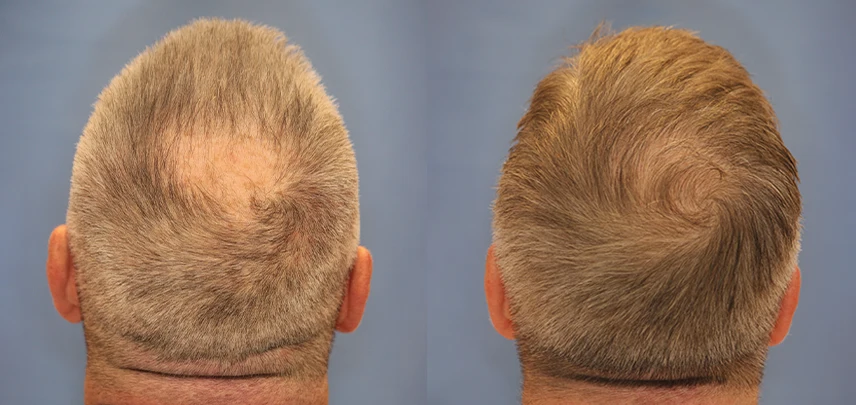Follicular Unit Excision – Patient 4 – Before & After