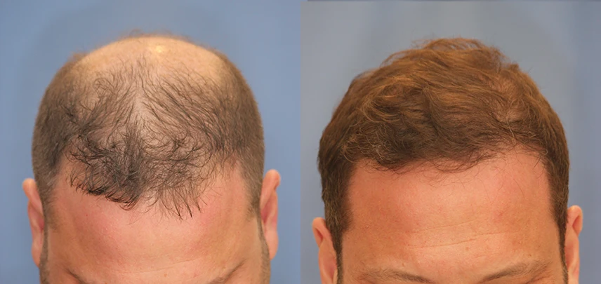 Follicular Unit Excision – Patient 5 – Before & After